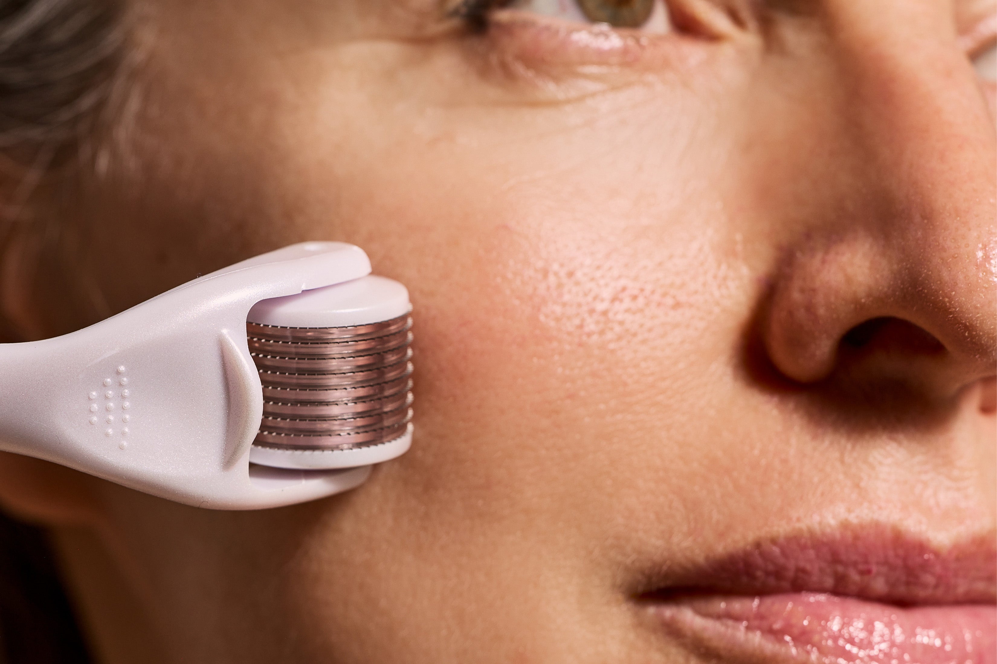 Microneedling