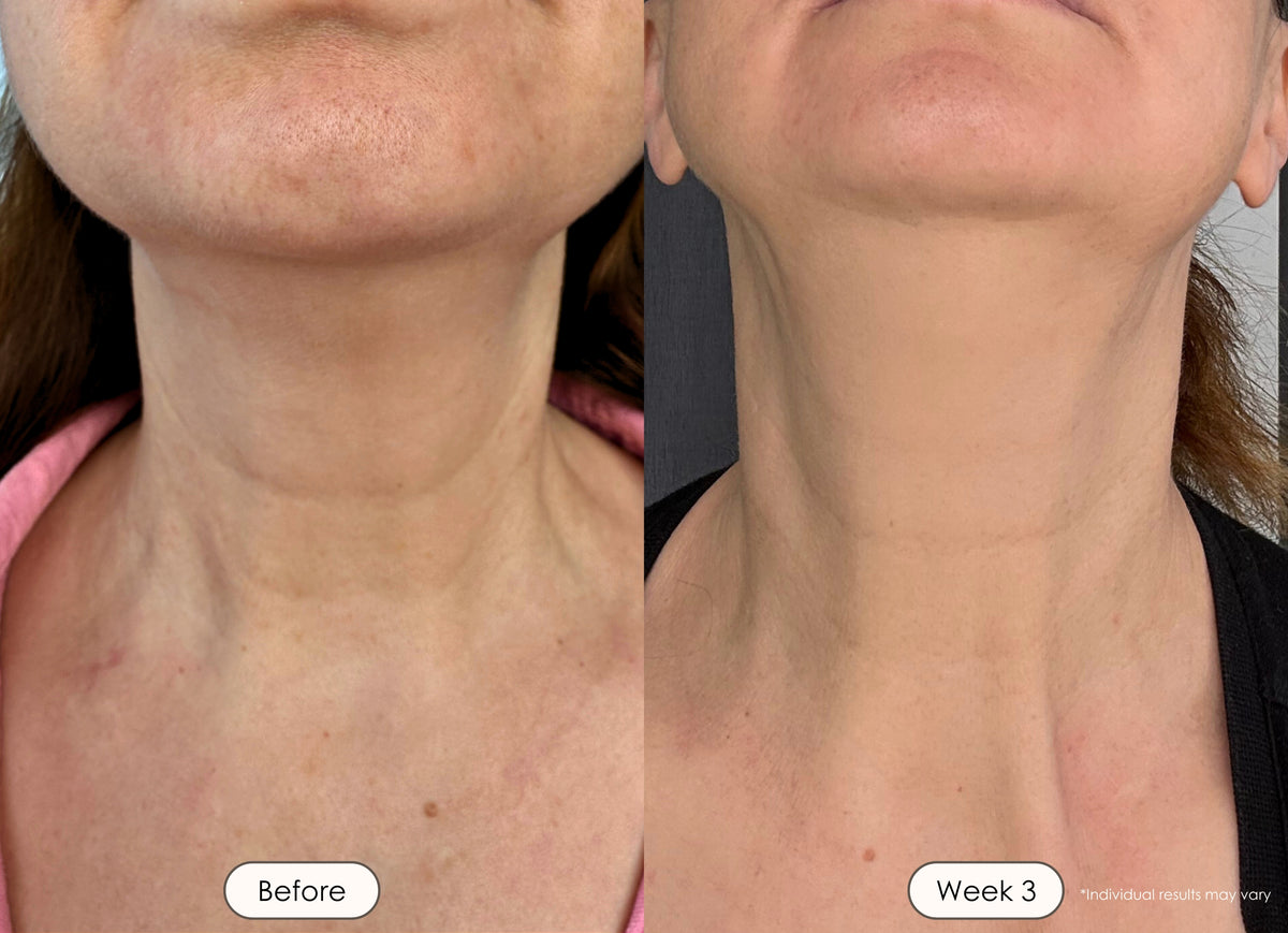 visible results after 3 weeks of using the LED light therapy neck and face mask
